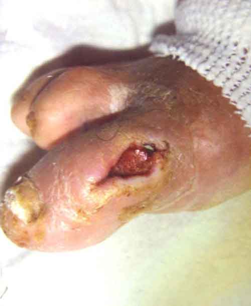 # Diabetic Foot Ulcers Pictures - new diabetes medicine ...